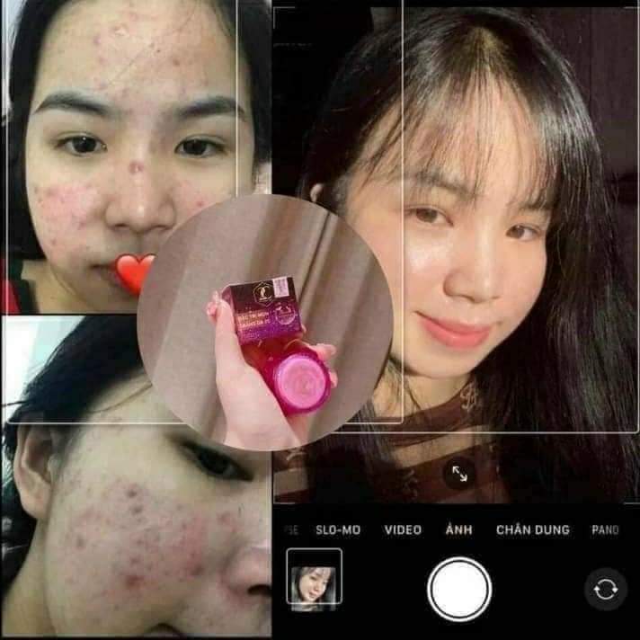 Kem mụn trắng da 2c chính hãng