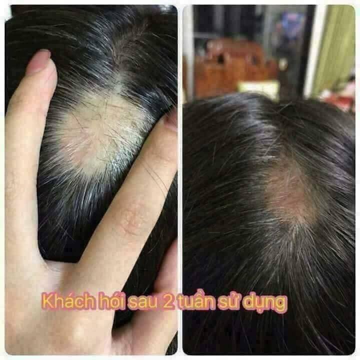 Tinh dầu bưởi xanh kích mọc tóc siêu dày và đẹp 100ml