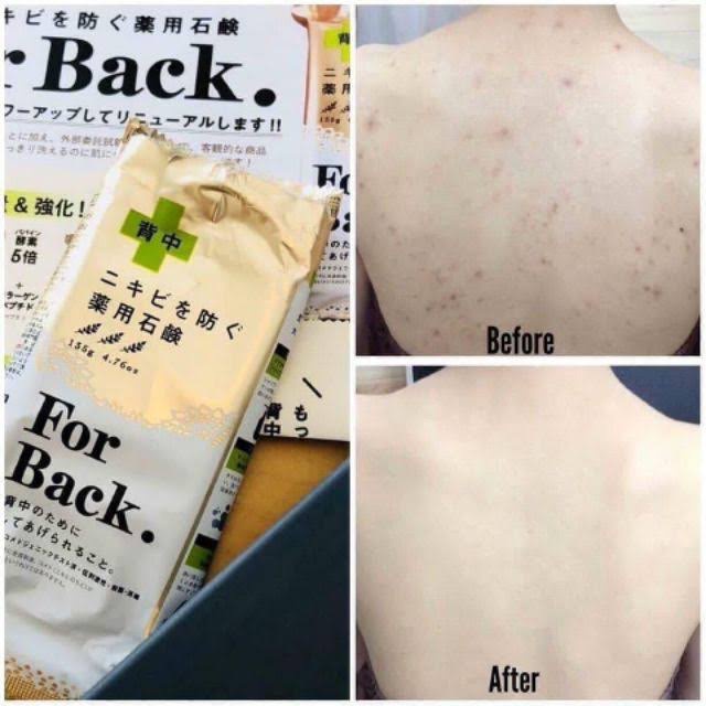 [Hàng chuẩn] Xà phòng mụn lưng For Back Nhật Bản 135g