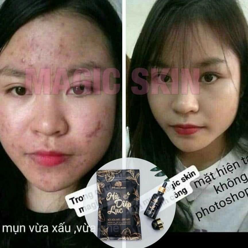 TINH CHÂT NGỪA MỤN ĐÔNG Y MAGIC SKIN
