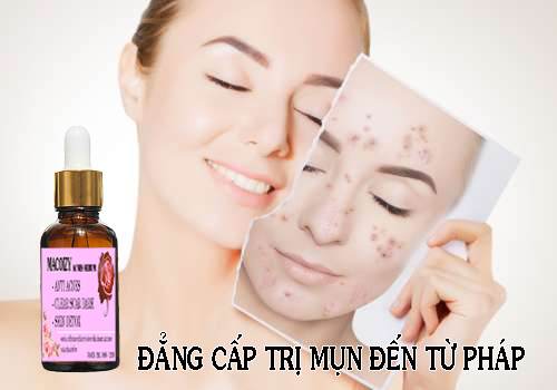 [HCM]Serum Giảm Mụn Mờ Thâm Macoizy Của Pháp