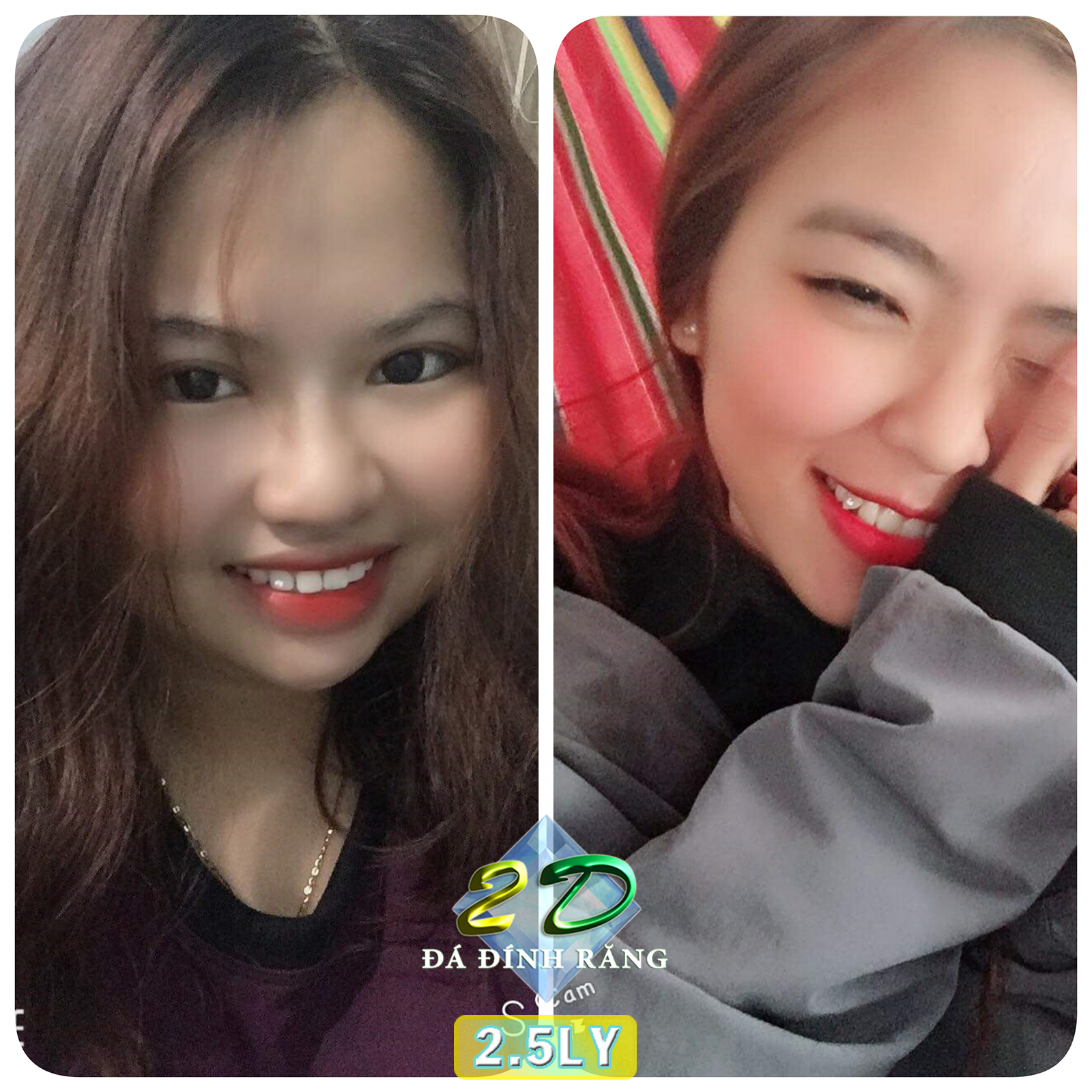 [HCM]Mua 1 tặng 1-Đá đính răng Thụy Sĩ 2.5LY (loại vừa đủ đẹp)
