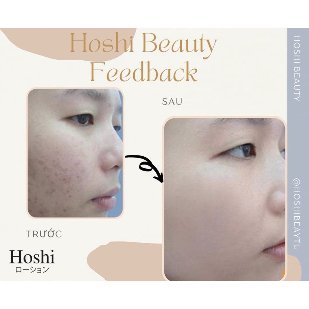 Bộ mờ nám, trắng da Hoshi Nhật Bản