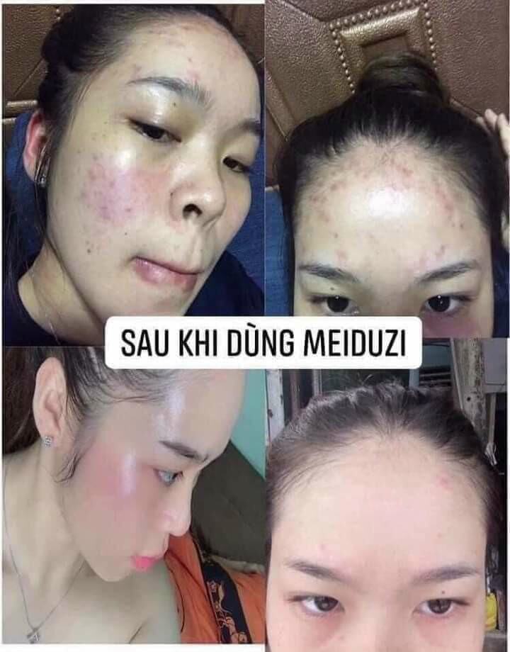 KEM MEDUZI NHẬT BẢN CHÍNH HÃNG