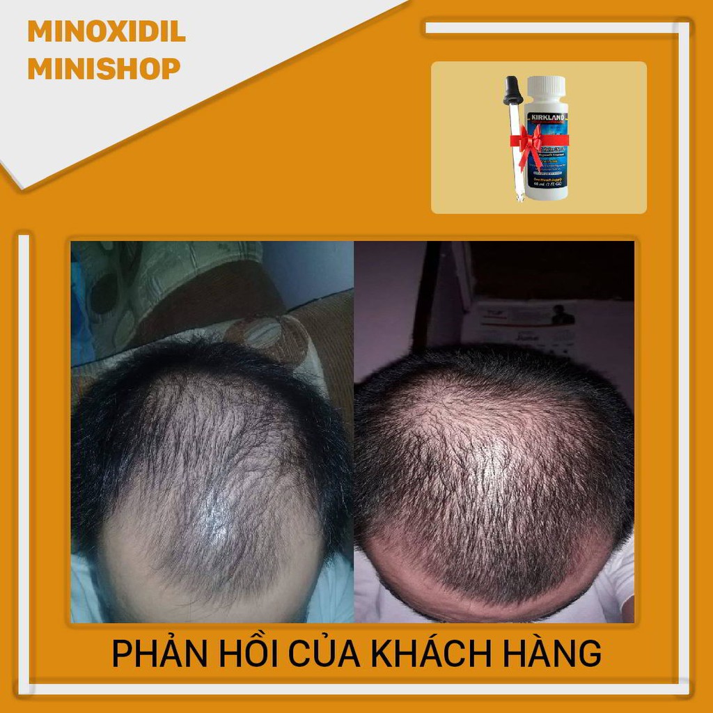 Minoxidil 5% Dạng Lỏng Mọc Râu Tóc Kirkland Mỹ