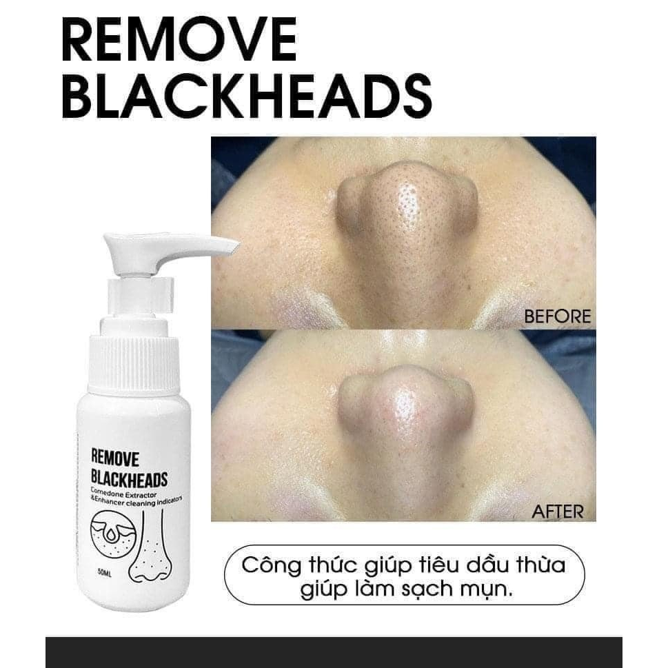 Ủ mụn đầu đen Remove BlackHeads - PHUONGANHOUSE