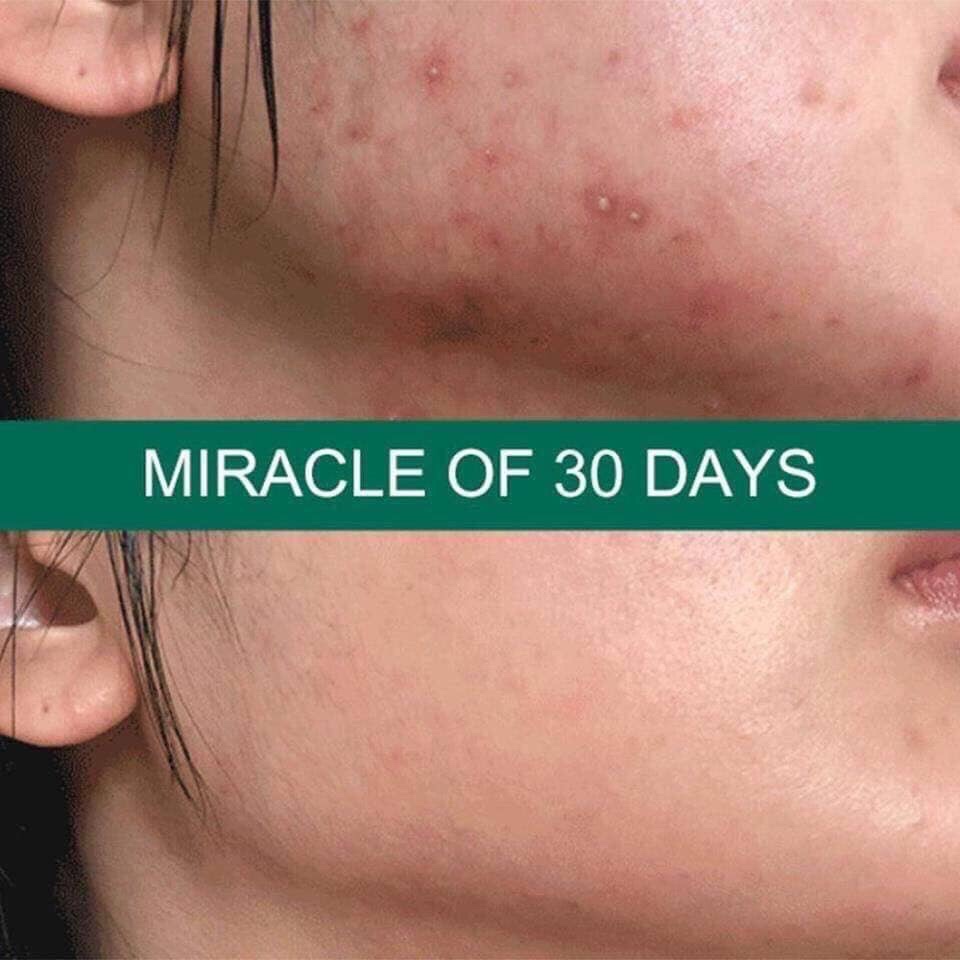 Kem Dưỡng Some By Mi AHA BHA PHA 30 Days Miracle Cream