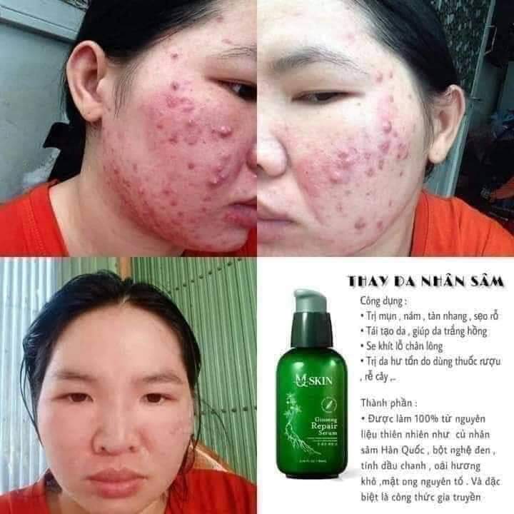 [HCM]Thay da Nhân Sâm MQSKIN