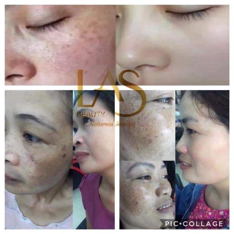 [CHÍNH HÃNG] KEM NÁM TẢO DR.SHEE LAS BEAUTY
