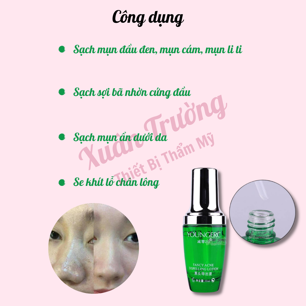 Ủ mụn đầu đen, mụn cám, Ủ mụn Youngerc chai 30ml