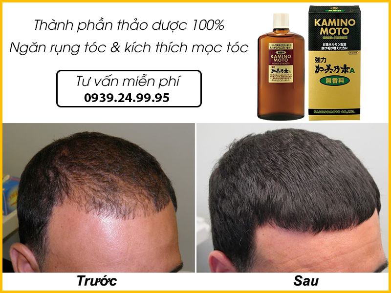 Sản phẩm mọc tóc Nhật Bản - Kaminomoto Higher Strength