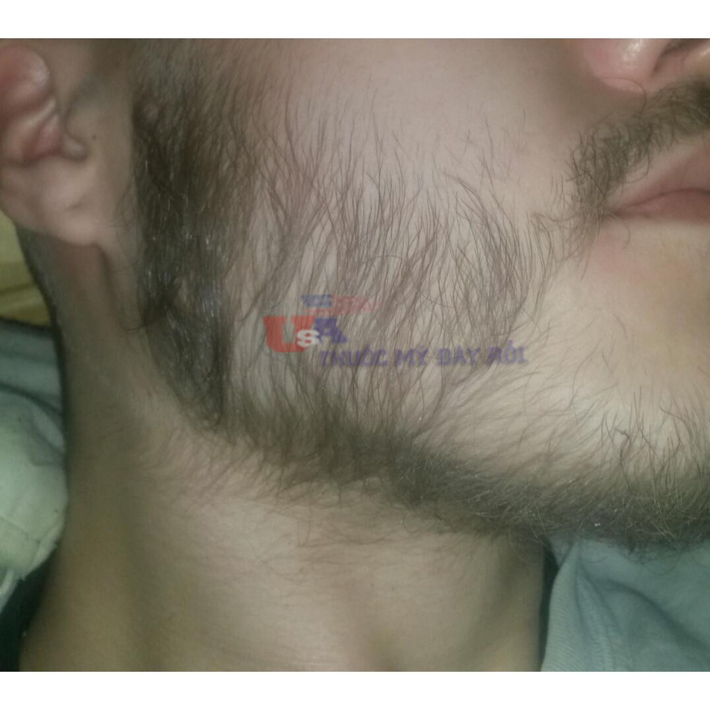 [HCM]Minoxidil 5% Mọc Râu Tóc Dạng Bọt ( Hộp 6 lọ )