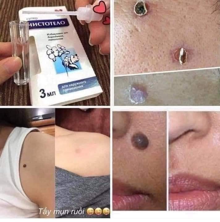 Gel tẩy nốt ruồi, mụn cơm mụn cóc, thịt thừa của Nga.