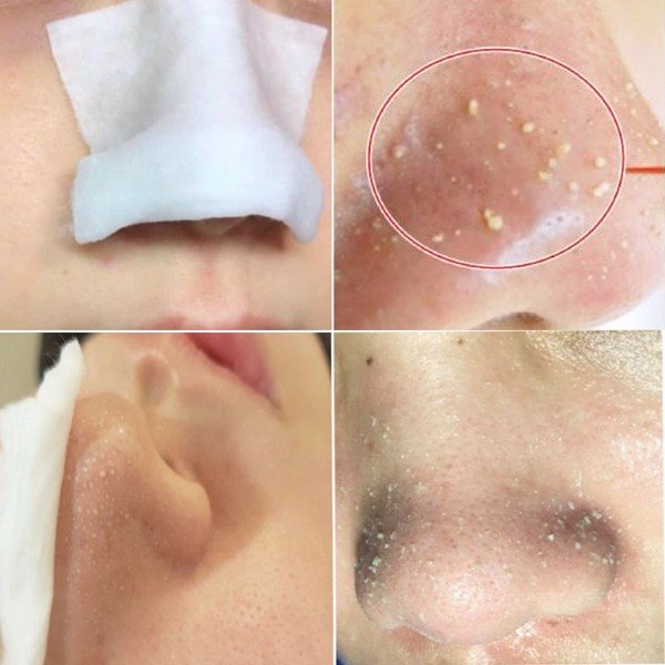Dung Dịch Ủ Mụn Medipeel Extra Super 100ml