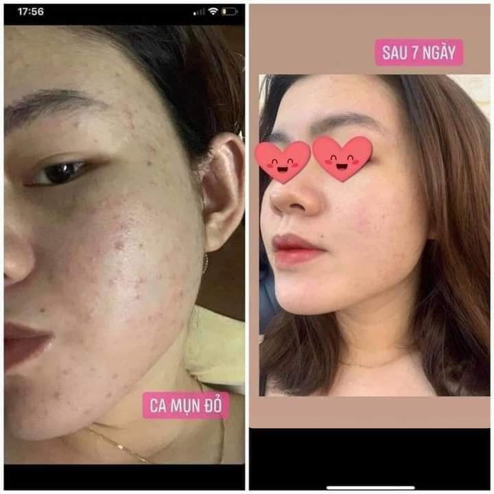 [HCM]Cao Mụn Sâm Đỏ 36 Vị Hộp Lớn 15g