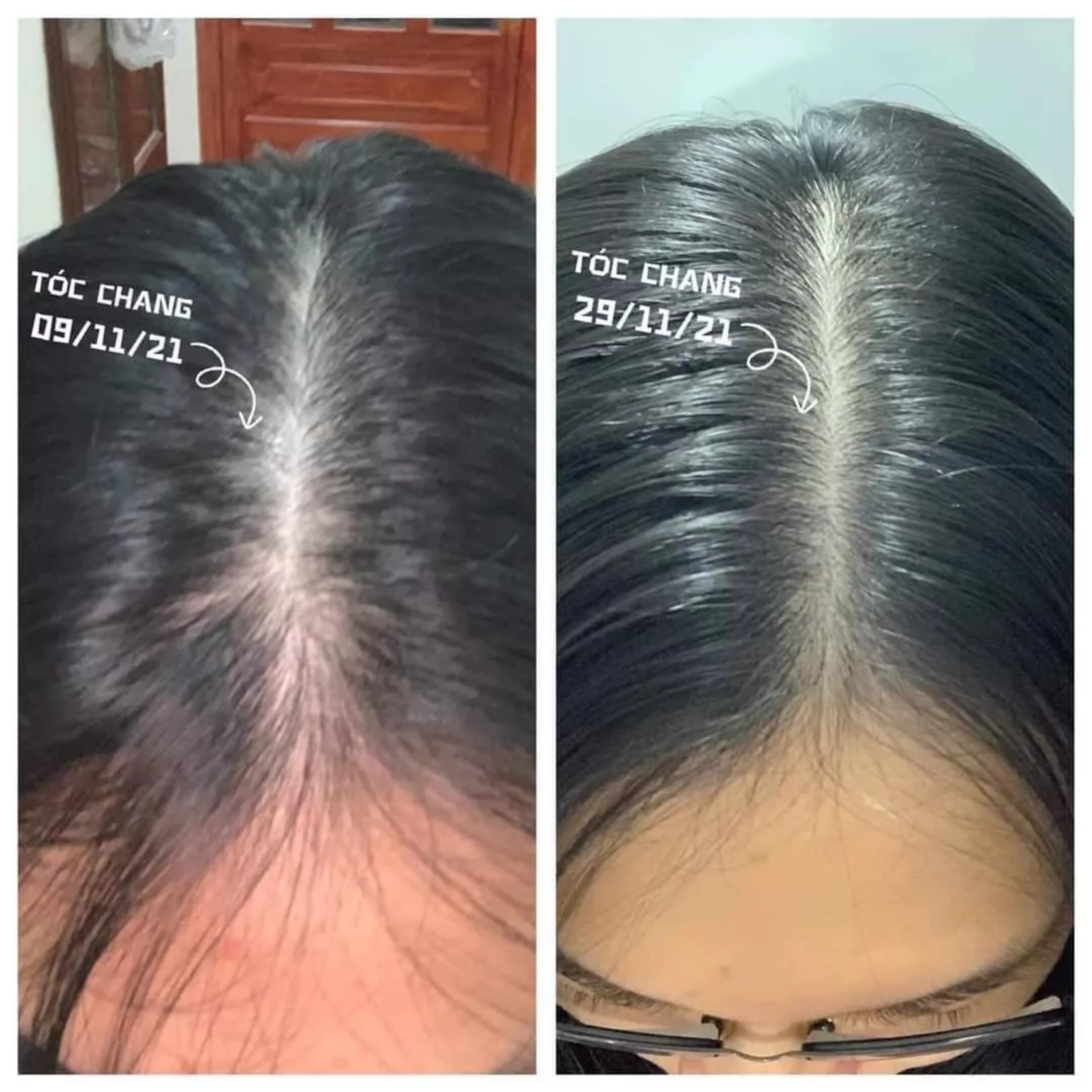 Xịt Mọc Tóc Minoxidil BAILLEUL 2%