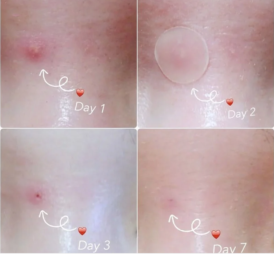 Miếng Dán Mụn Cosrx Acne Pimple Master Patch 24 Miếng Acne Pimple Master Patch