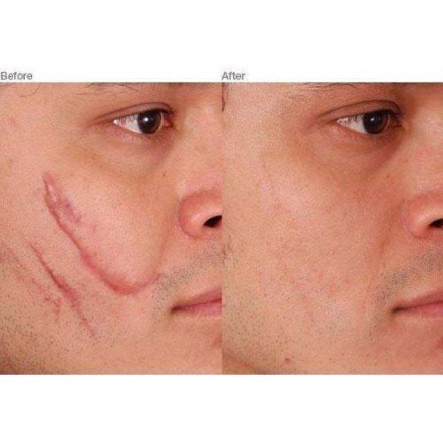 Kem Làm Mờ Sẹo Xóa Xăm