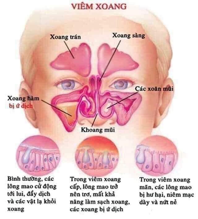 [HCM]ĐẶC TRỊ VIÊM XOANG MŨI HÀN QUỐC