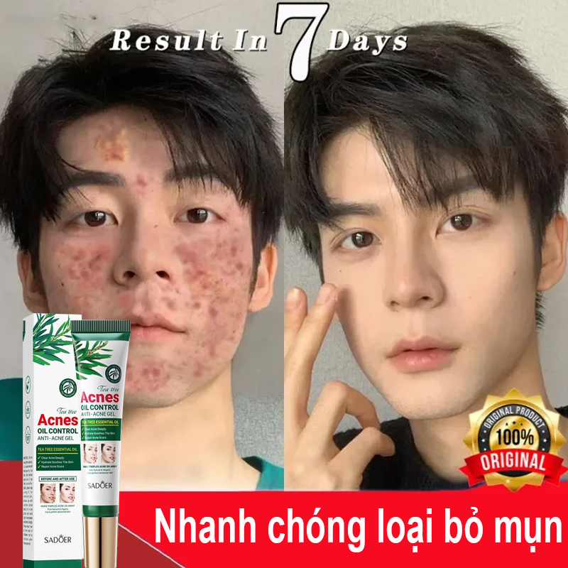Kem Giảm Mụn Cấp Tốc Loại Bỏ Mụn và Vết Thâm Hoàn Toàn Thu Nhỏ Lỗ Chân Lông Acne Giúp Da Láng Mịn Khít Lỗ Chân Lông Kiểm Soát Dầu 20g, loại bỏ các loại mụn, mụn ẩn, mụn đầu đen, mụn ở tuổi dậy thì