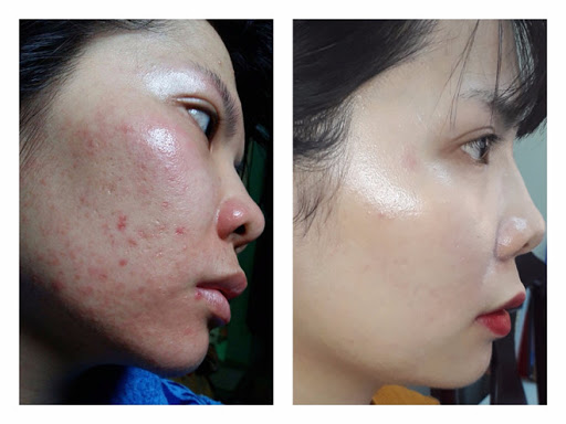 Chấm mụn siêu tốc Linh Sâm 12 lọ