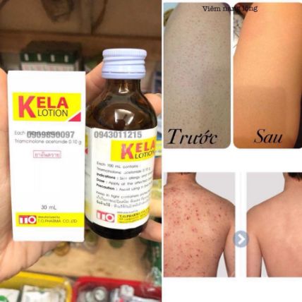 SERUM KELA LOTION -  VIÊM LỖ CHÂN LÔNG 30ml