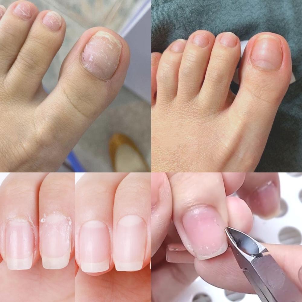 Que đẩy da chết, cây sủi da đẩy móng Nghi Thảo