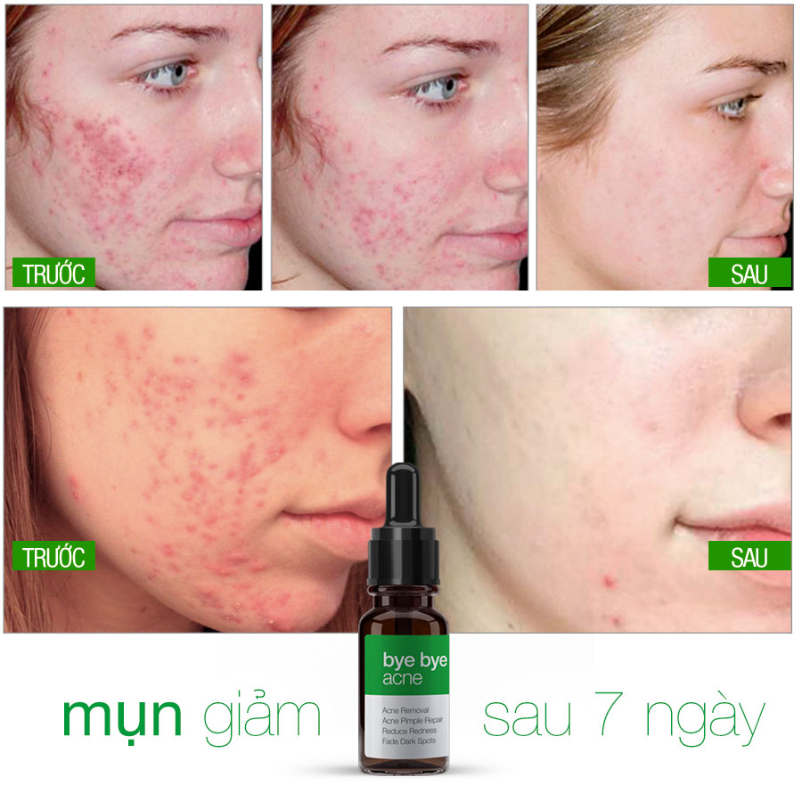 TẠM BIỆT MỤN BYE BYE BLEMISH for Acne LANGCE