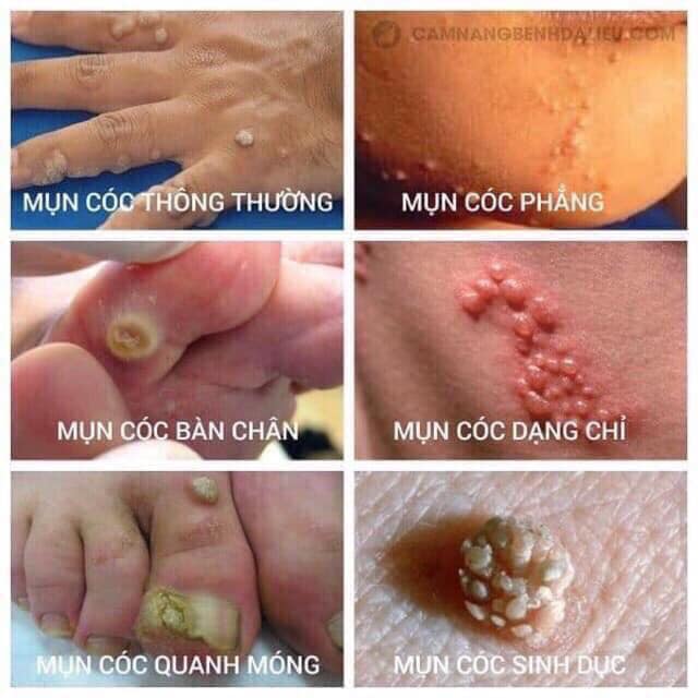 Bôi Mụn Cóc-Mụn Cơm-Nốt Ruồi CONCON Thái Lan
