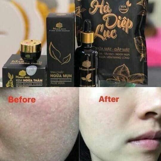 TINH CHÂT NGỪA MỤN ĐÔNG Y MAGIC SKIN
