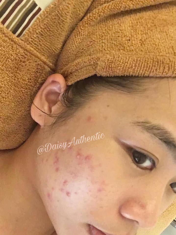 Benzac AC 5% Benzoyl Peroxide 15g - KEM GIẢM MỤN