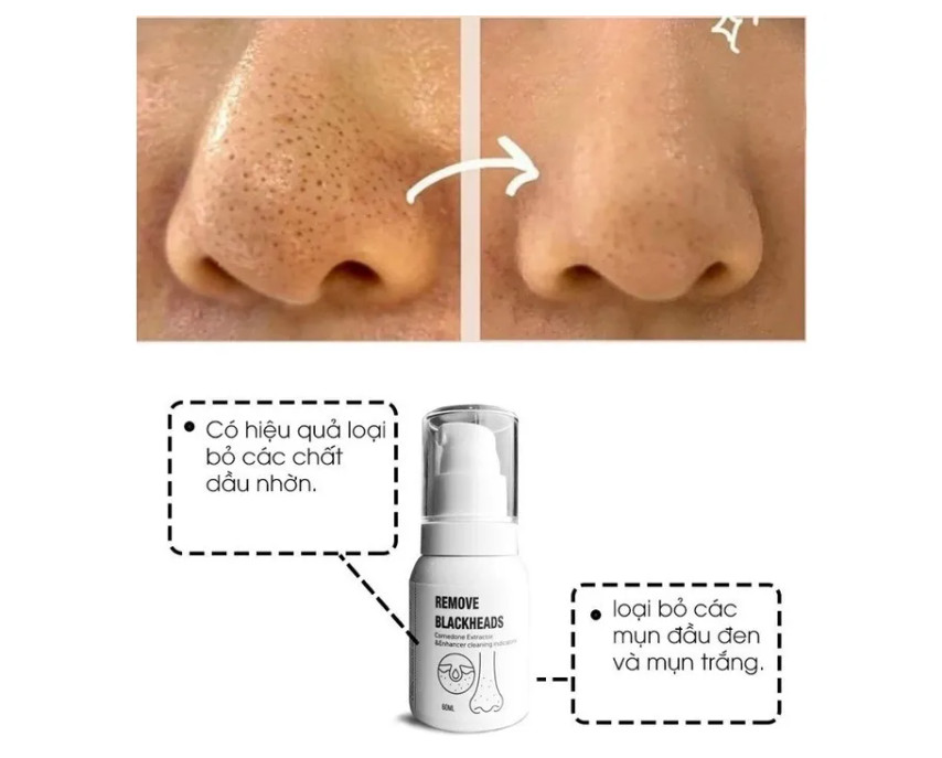Ủ mụn đầu đen removes blackheads hỗ trợ giảm sợi bã nhờn 50ml