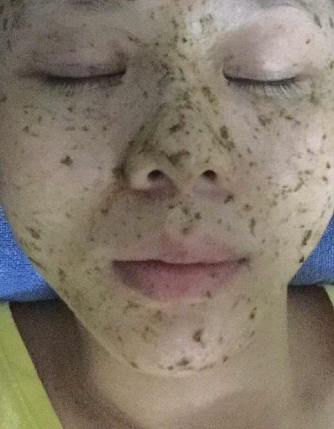 Cỏ trị nám, tàn nhang Lý Gia .