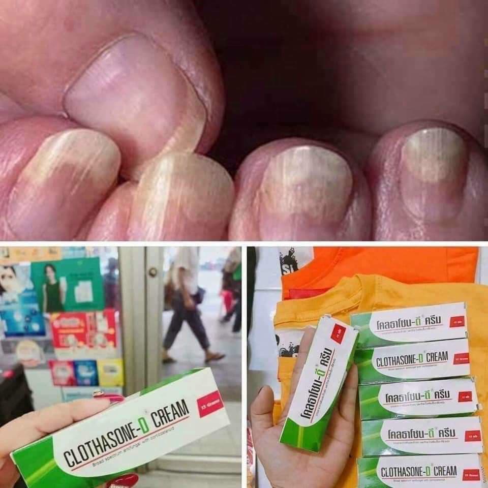 Kem Bôi Nấm Móng Tay Chân CLOTHASONE-D Thái Lan