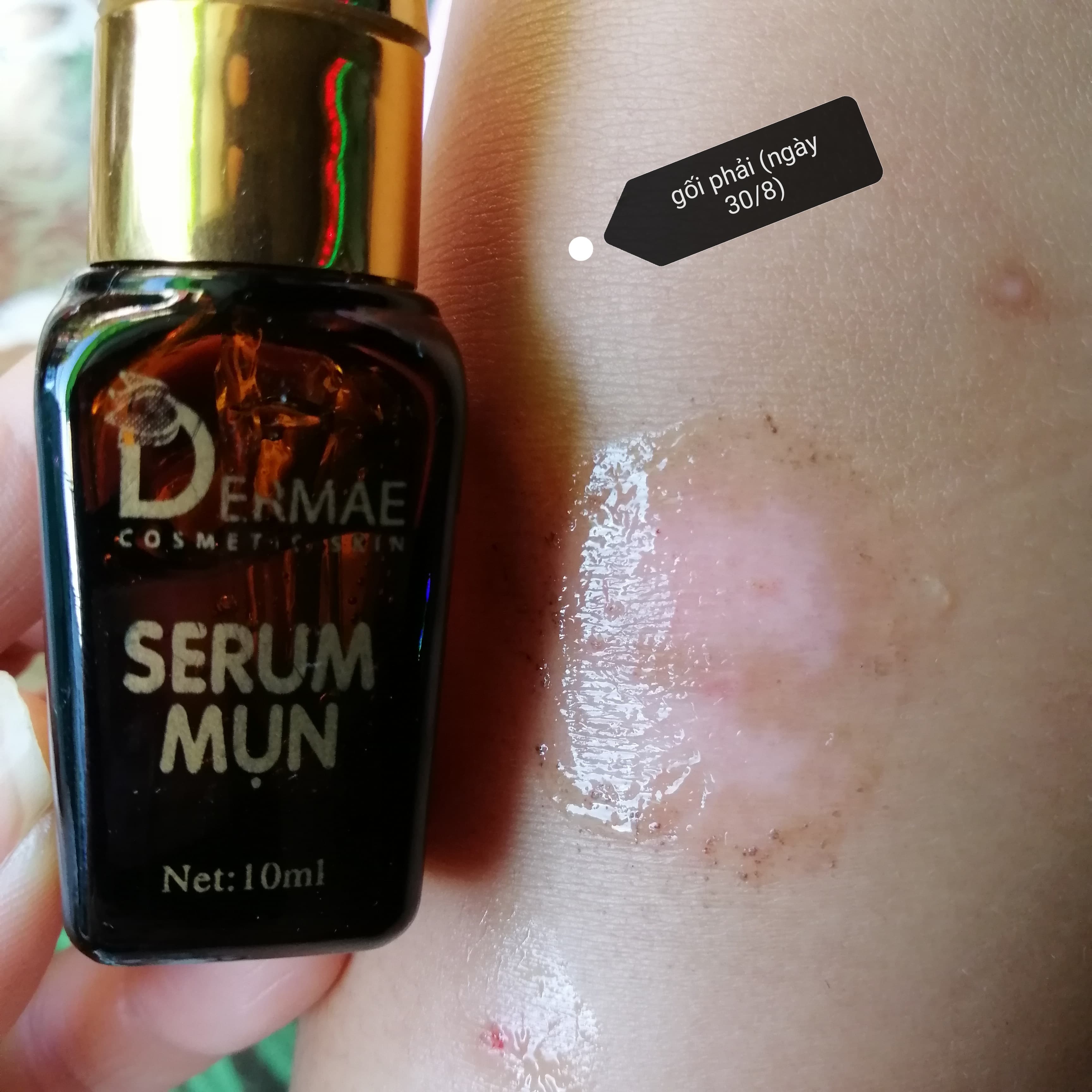 [HCM]SERUM MỤN DERMA PLUS