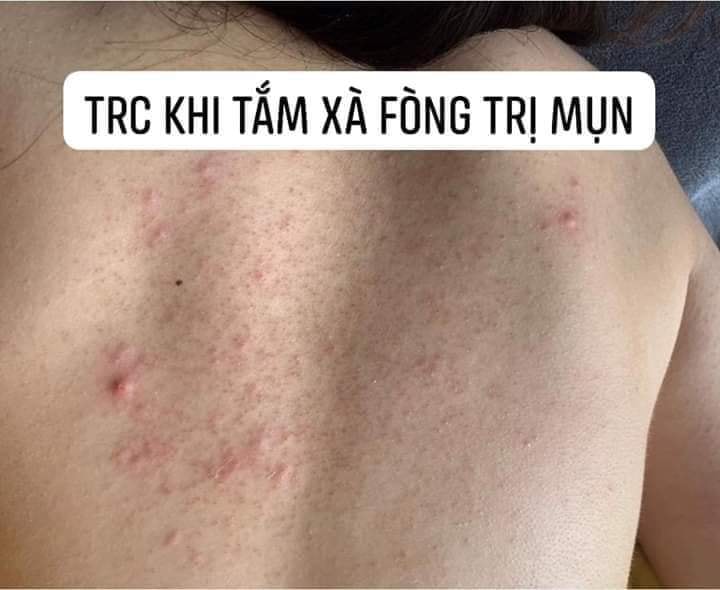(Chuẩn Auth) Xà Phòng Loại Bỏ Mụn Lưng Tar NC Nga