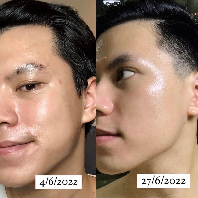 Serum Oh Oh Niacinamide 20 D ng S ng Da Gi m Th m N m Thu Nh L Ch n serum-oh-oh-niacinamide-20-d-ng-s-ng-da-gi-m-th-m-n-m-thu-nh-l-ch-n