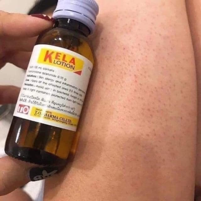 Kela Lotion Đtri Viêm Lỗ Chân Lông Dứt Điểm