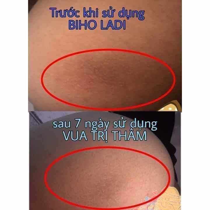 [HÀNG CHÍNH HÃNG] Siêu Dưỡng Thâm 5s Biho ladi