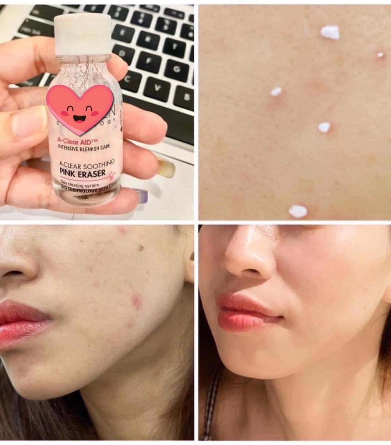 Chấm mụn Neogen A-clear Soothing Pink Eraser