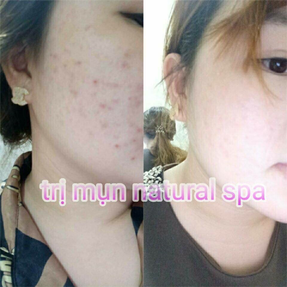 Kem Ngăn Ngừa Mụn Acne Dr Cell 30g dưỡng trắng mờ thâm mụn giảm mụn ngăn ngừa mụn