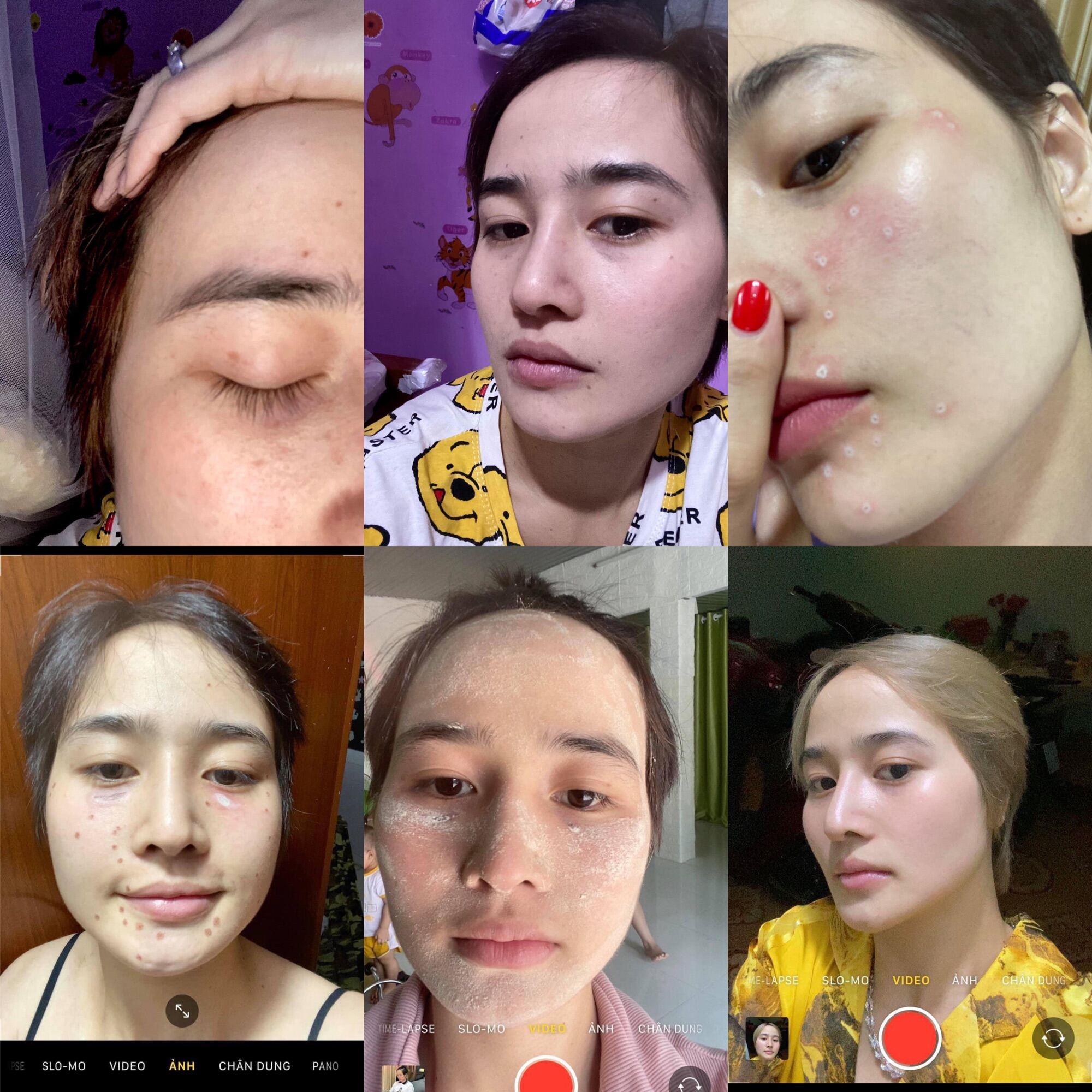 CHẤM TÀN NHANG MỤN NÁM RỖ PHƯƠNG ANH