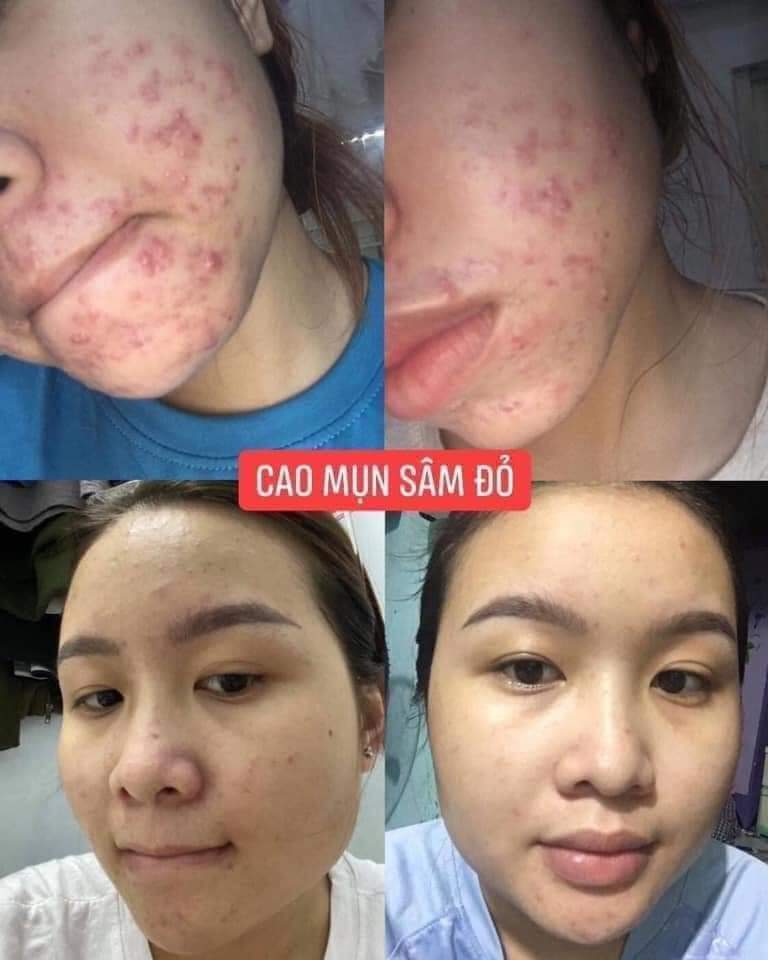 [HCM]SỮA RỬA MẶT MẬT NHÂN SÂM 36 VỊ (CAO MỤN SÂM ĐỎ)
