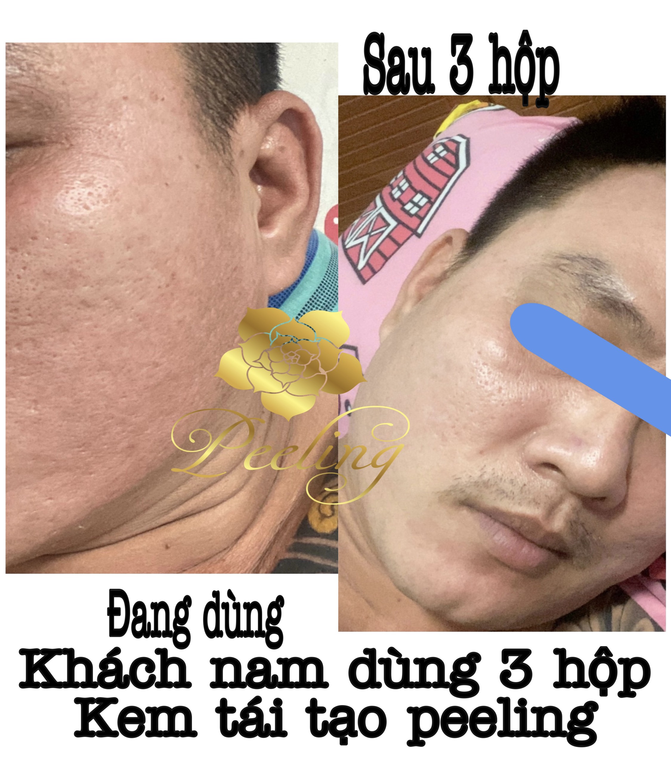 [HCM]5 Hộp Kem Peeling Tái Tạo Da