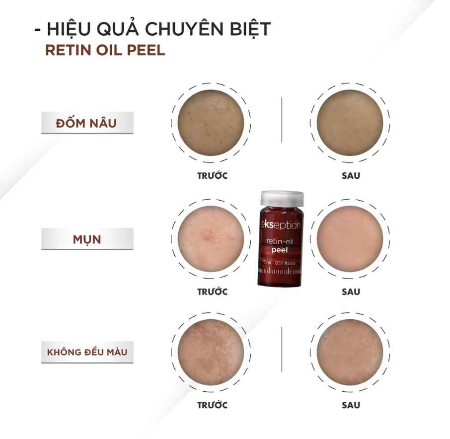 Tinh chất Peel da Ekseption Retin-oil peel 5ml