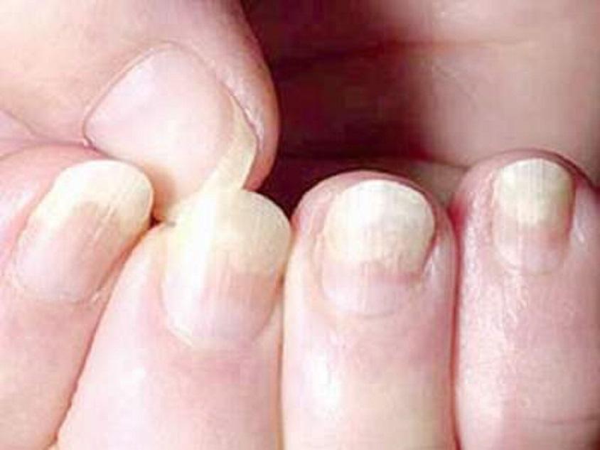 Emtrix khắc phục loạn dưỡng móng, móng ố đen