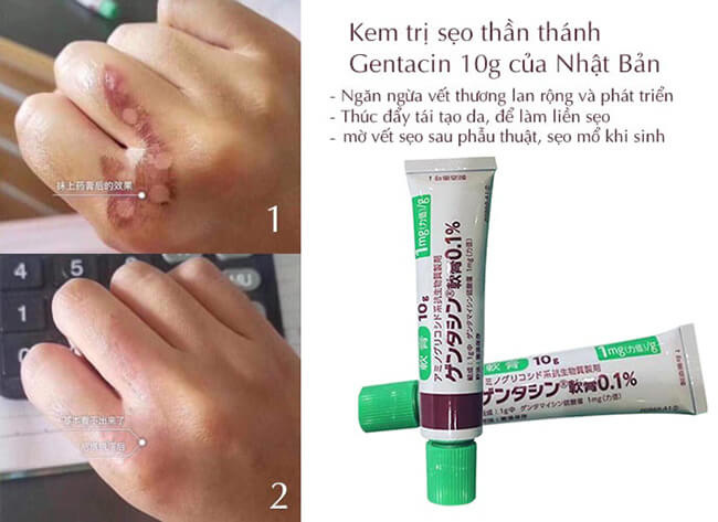Serum tẩy Mụn Cóc - Gel Tẩy Nốt Ruồi