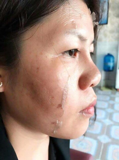 Peel Trắng Bong Da Xóa Nám Sạm