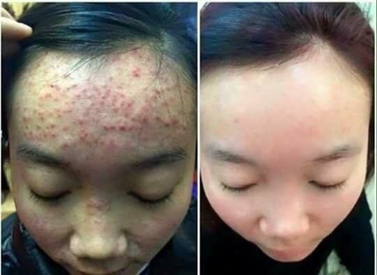 COMBO TÁI TẠO DA ( Tạm biệt mụn )