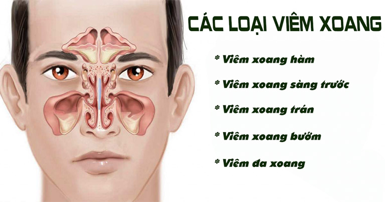 DẦU VIÊM XOANG